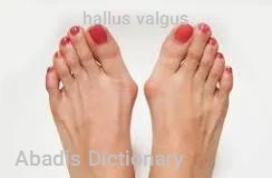 hallus valgus
